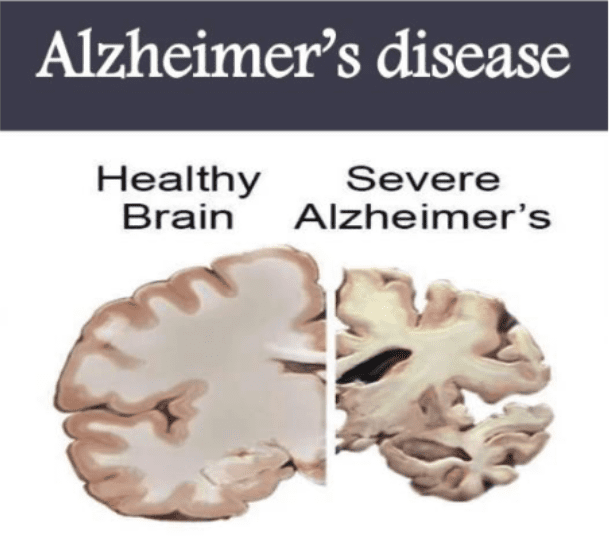 alzheimer's disease inside look at the brain